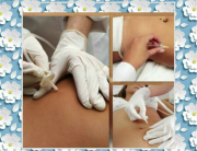 carboxiterapia