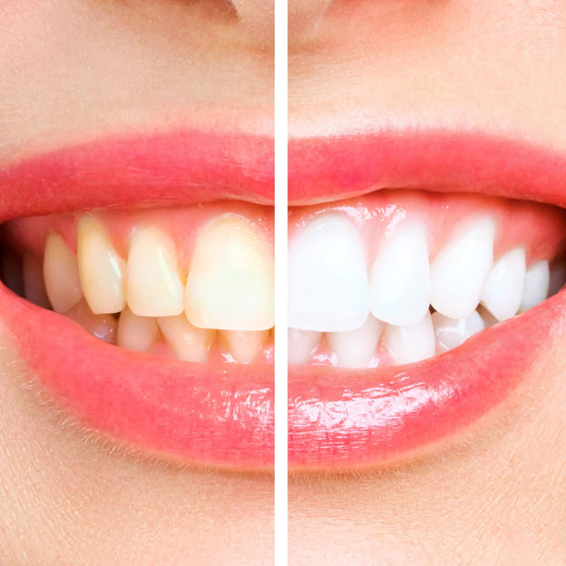 Clareamento Dental na Vila Clementino