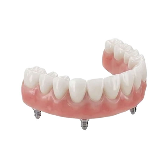 Prótese protocolo sobre implantes